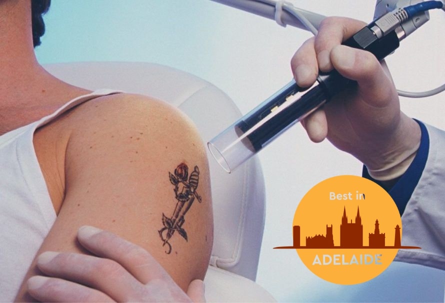 The Tattoo Removal CoLaser Tattoo Removal Adelaide